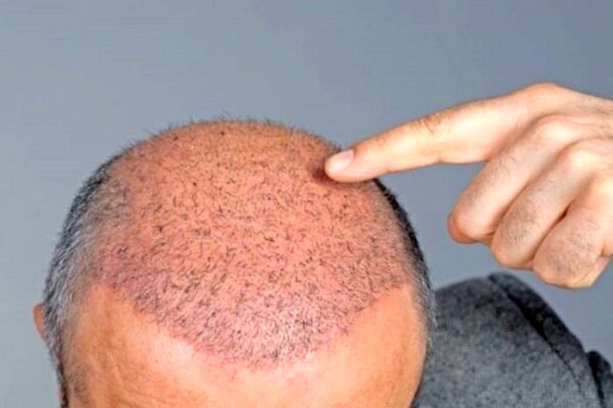 نکات مهم و کلیدی درباره کاشت مو