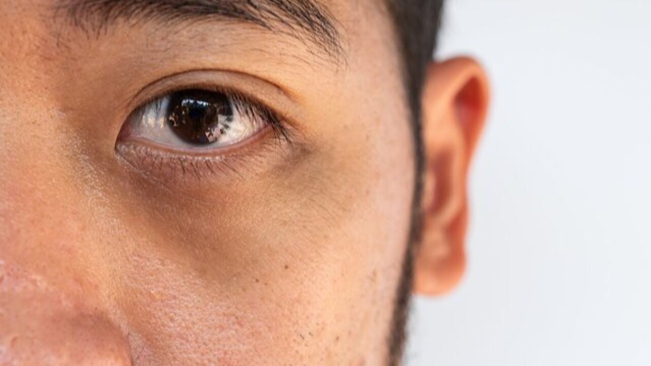 دلایل ایجاد تیرگی دور چشم‌ها
