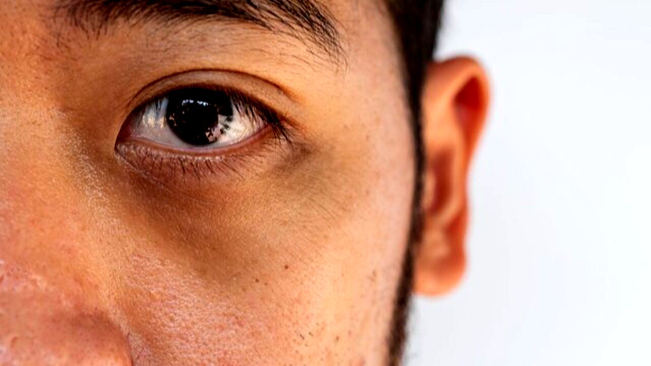 دلایل ایجاد تیرگی دور چشم‌ها