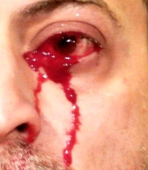 مرد بخت برگشته‌ای که خون از چشمانش می‌بارد