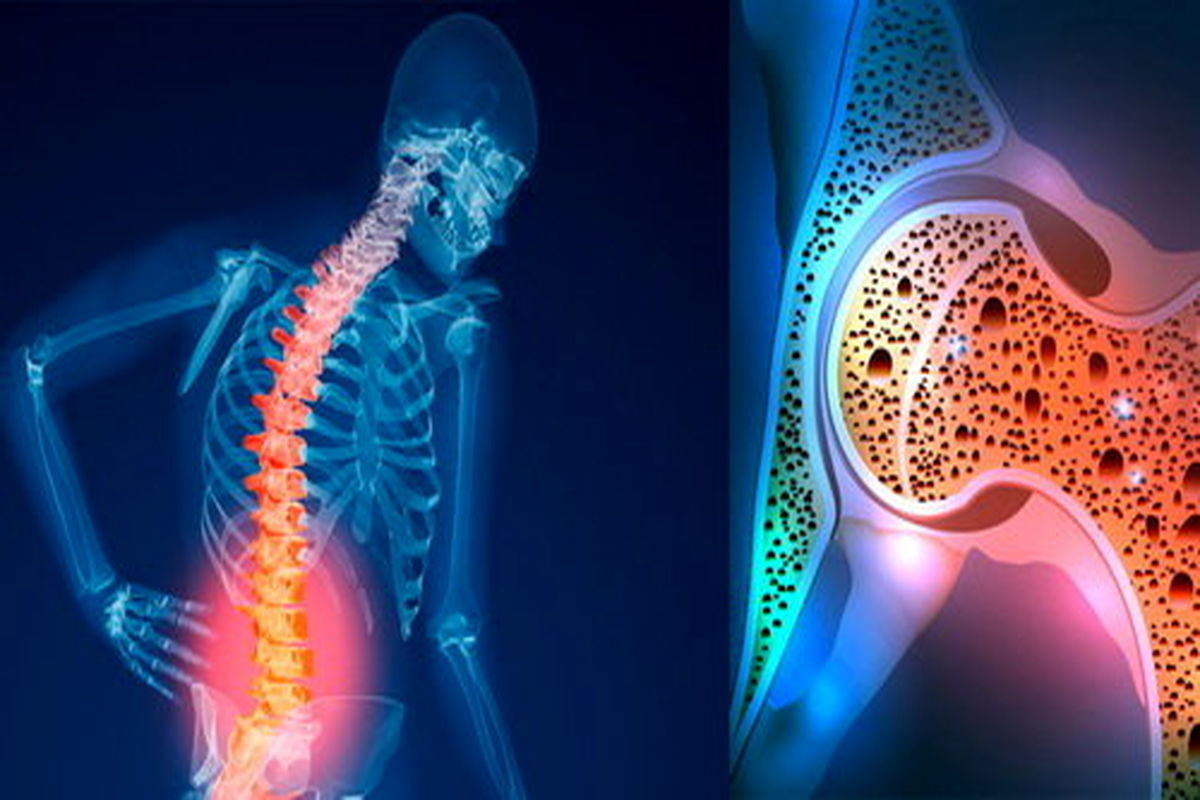 دلایل اصلی ابتلا به پوکی استخوان