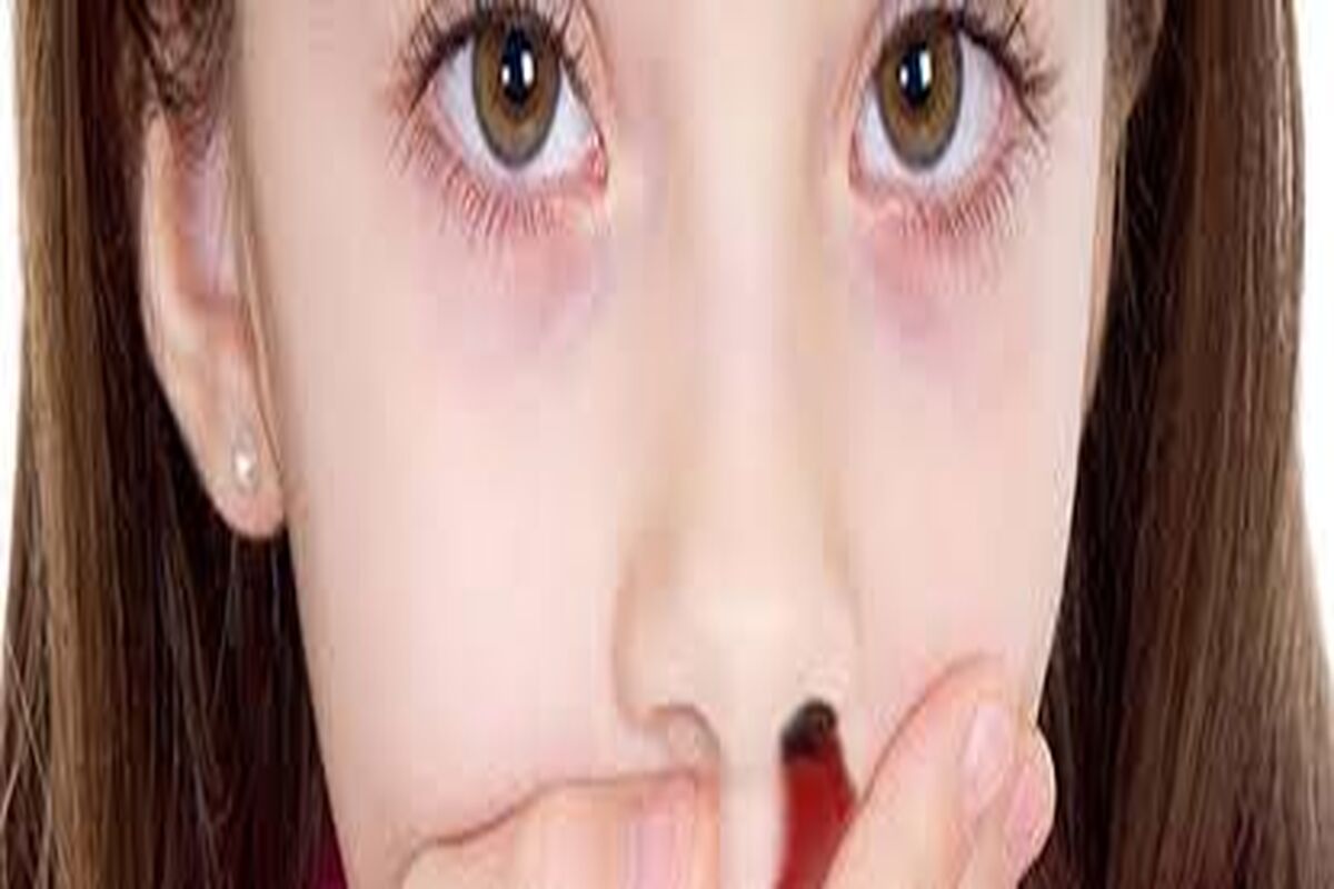 چرا خون دماغ می‌شویم؟