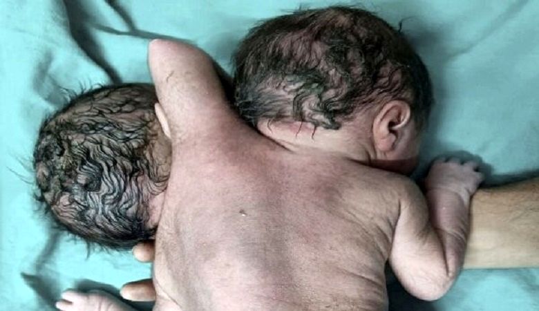تولد یک نوزاد 2 سر با 3 تا دست/ عکس +18