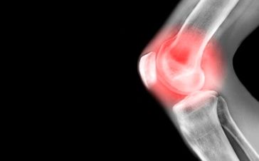 اقداماتی که برای مبتلایان به آرتروز باید انجام شود