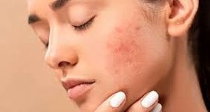 چند روش عالی که جای جوش صورت را محو می‌کند!