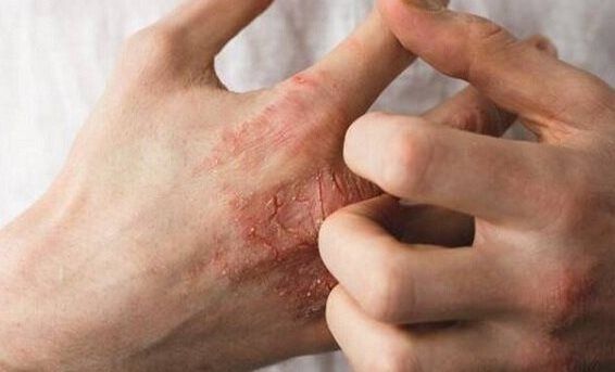 تشدید بیماری اگزما با داشتن اضطراب
