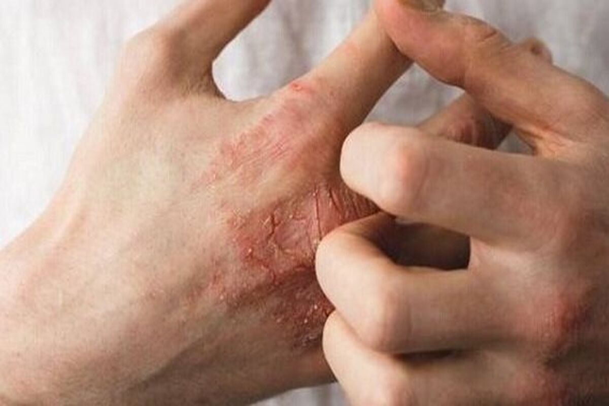 تشدید بیماری اگزما با داشتن اضطراب