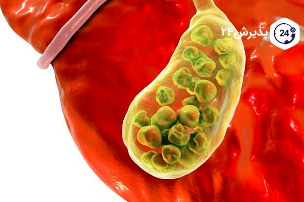 هشدار؛ با این علائم شما سنگ صفرا دارید!