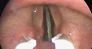 گیر کردن سکه بین تار‌های صوتی یک نوجوان به شکلی عجیب و غریب 