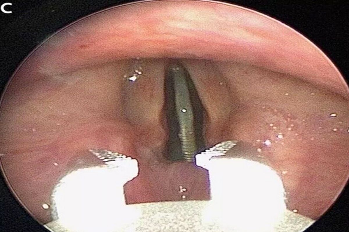 گیر کردن سکه بین تار‌های صوتی یک نوجوان به شکلی عجیب و غریب 