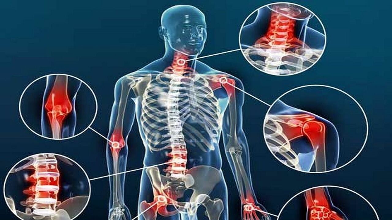 این مواد غذایی علائم آرتروز را تشدید می‌کنند !