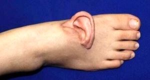 نجات لاله گوش زن جوان با پیوند موقت روی پا