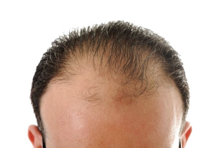 رهایی ریزش مو با روش‌های طبیعی