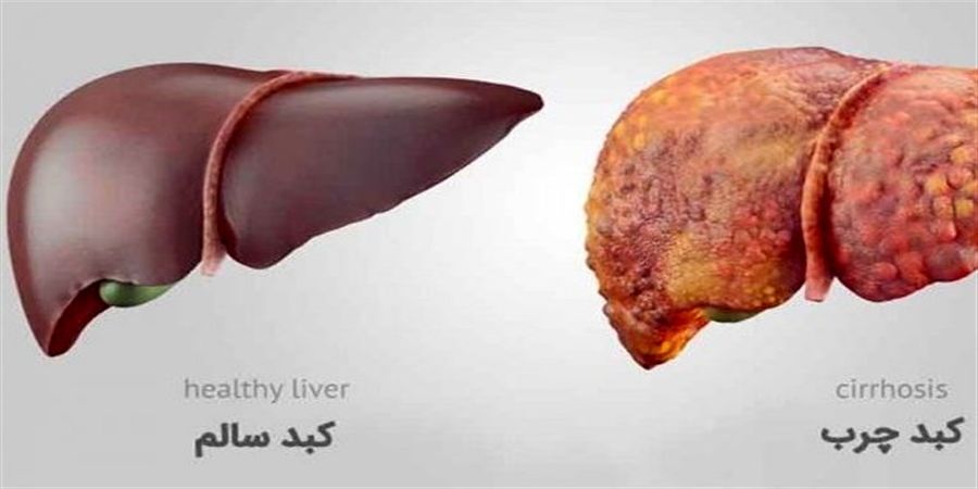 اگر این نشانه ها را دارید کبدتان مشکل دارد! + علائم کبد چرب و بیماری های کبدی / عکس