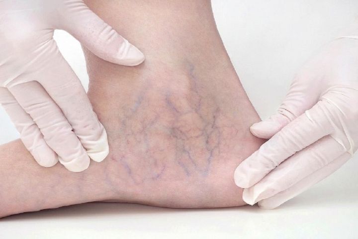 آشنایی با علائم و راه‌های درمان واریس