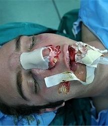 جراحی بینی بدون بیهوشی توسط دستیار دیپلمه پزشک مدعی!