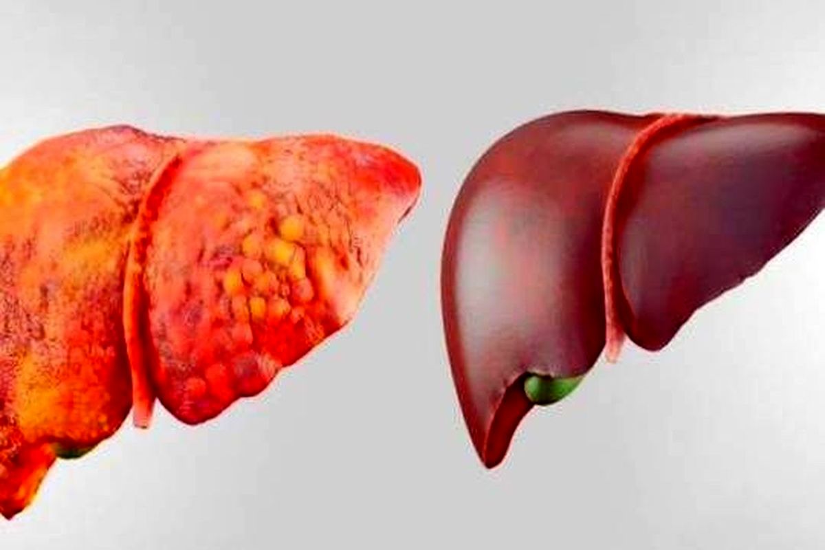 علل اصلی شیوع خاموش بیماری کبد چرب چیست؟