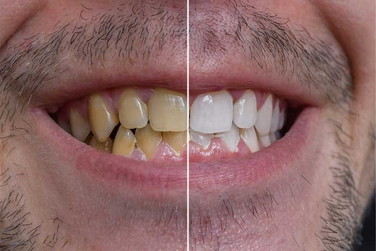 ترفند آسان برای رفع جرم دندان 