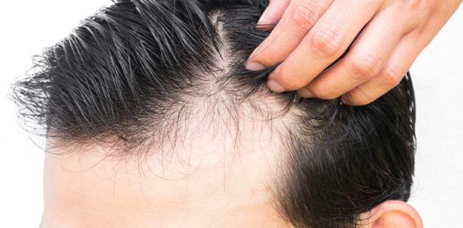 خوراکی‌های مضر برای ریزش مو